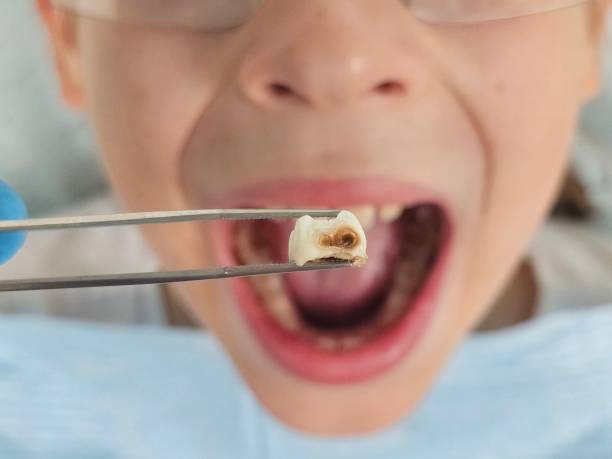 Best Emergency Wisdom Teeth Removal in Columbia, KY